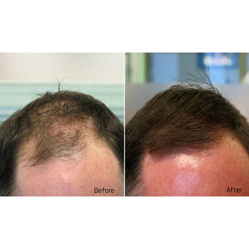 hairloss treatments